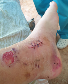 Leg after surgery stitches MArch 2021 stan tatiana dok tok medical.png